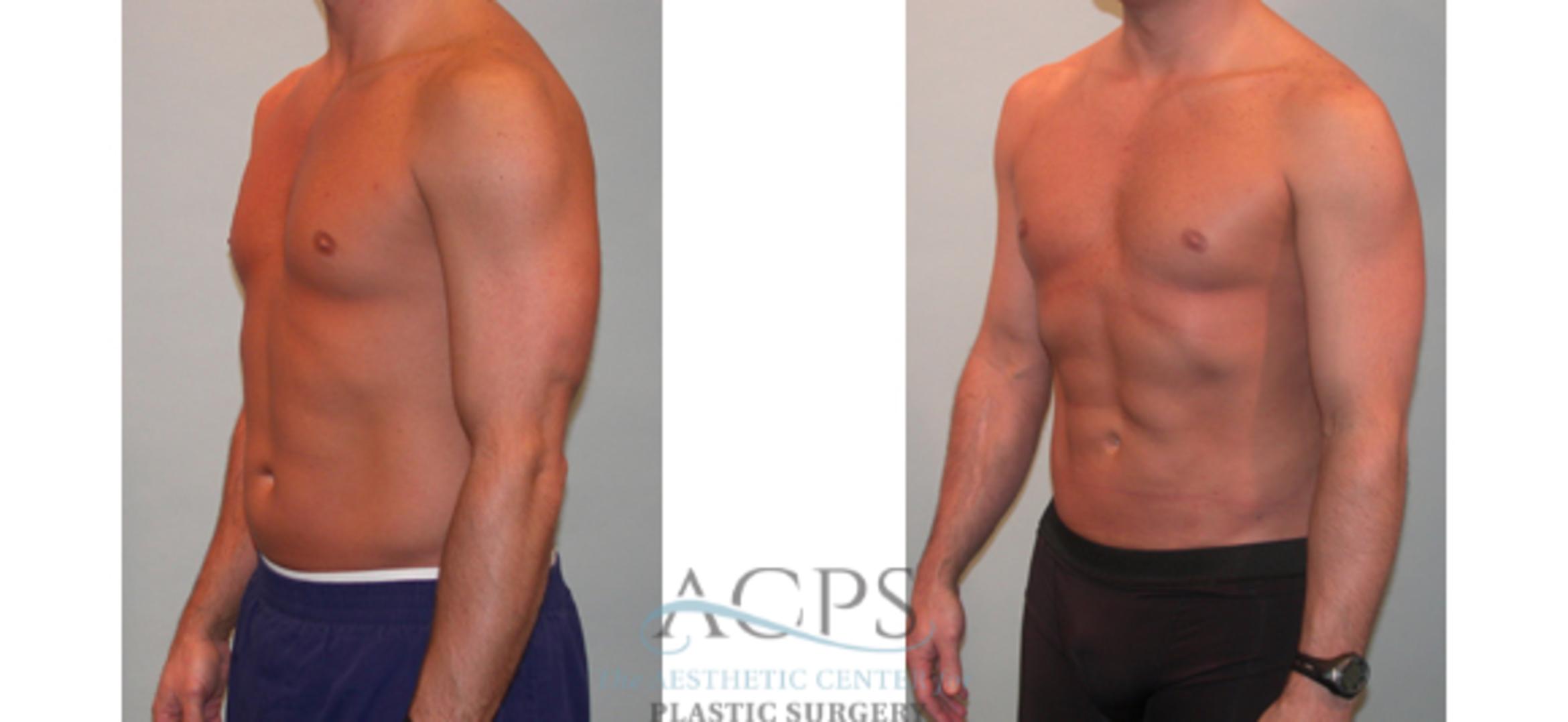 Before & After Abdominal Etching Case 798 Oblique View: View in Houston, TX