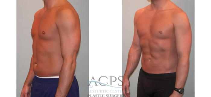 Before & After Abdominal Etching Case 798 Oblique View: View in Houston, TX