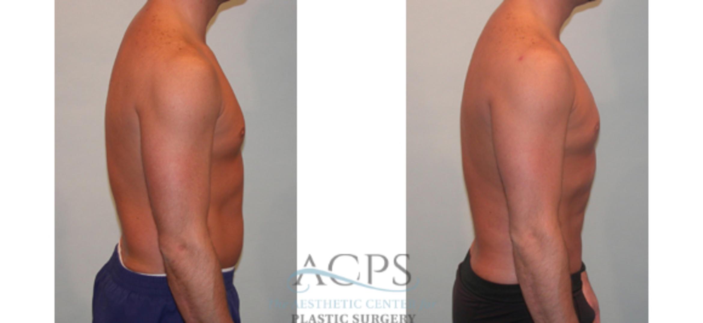 Before & After Abdominal Etching Case 798 Side View: View in Houston, TX
