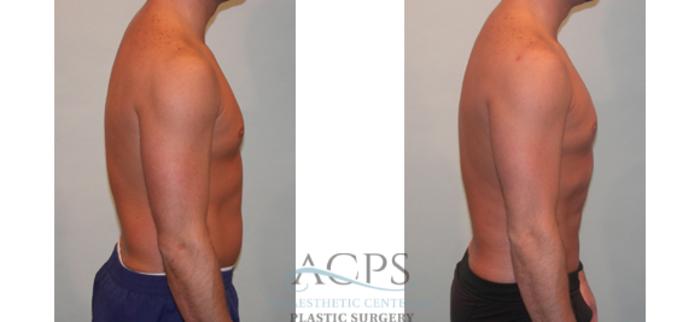 Before & After Abdominal Etching Case 798 Side View: View in Houston, TX