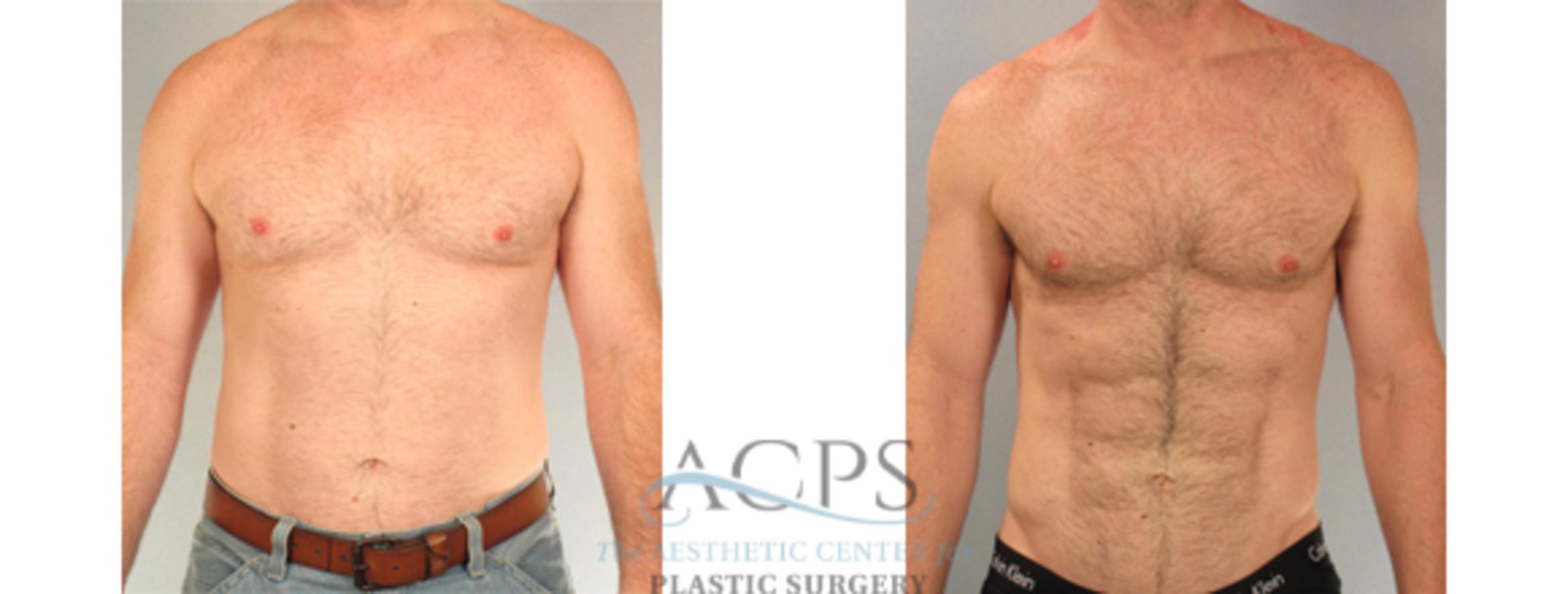 Before & After Abdominal Etching Case 799 Front View: View in Houston, TX