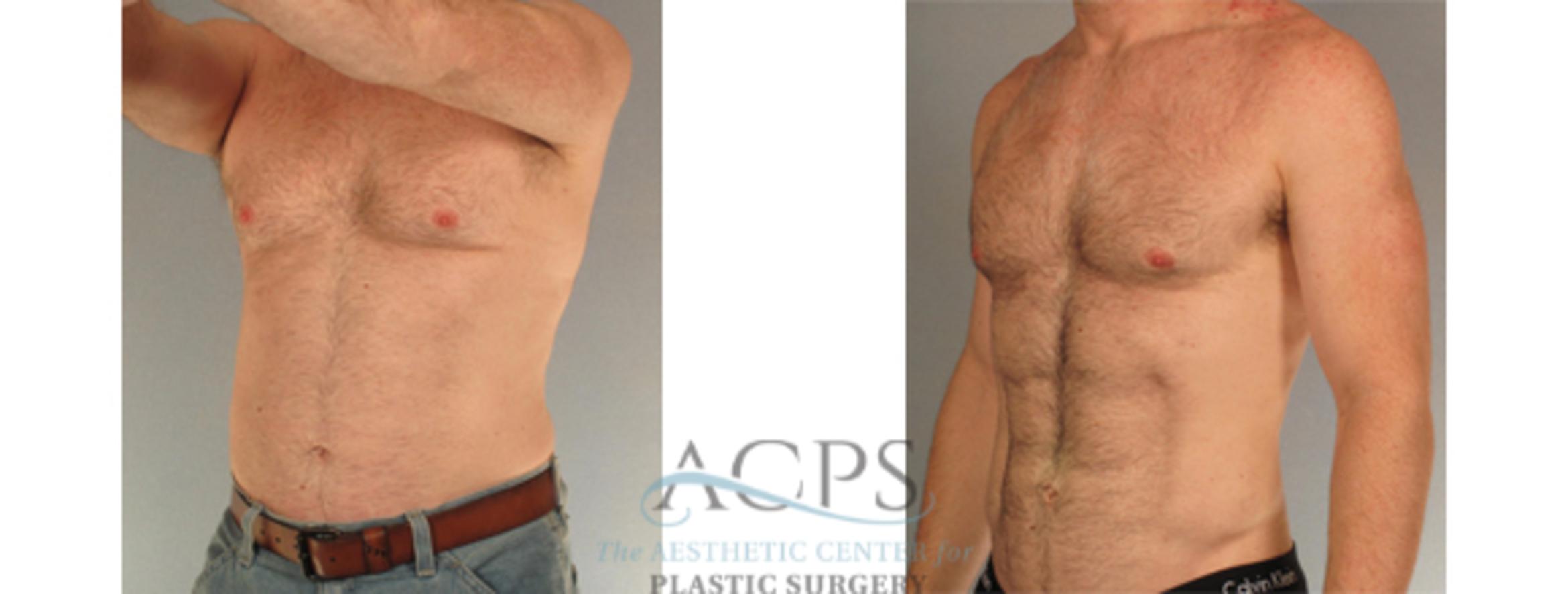 Before & After Abdominal Etching Case 799 Oblique View: View in Houston, TX