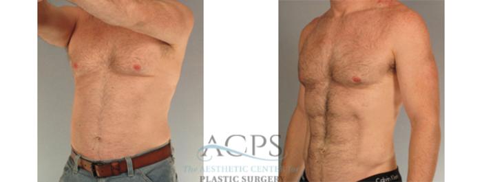 Before & After Abdominal Etching Case 799 Oblique View: View in Houston, TX