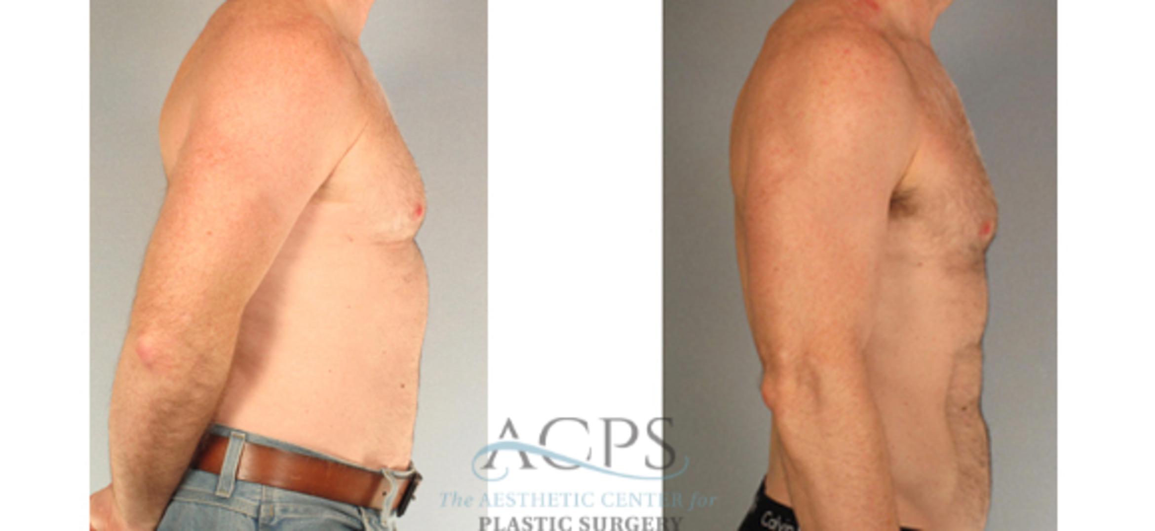 Before & After Abdominal Etching Case 799 Side View: View in Houston, TX
