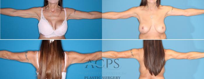 Before & After Arm Lift Case 1529 Front View in Houston, TX
