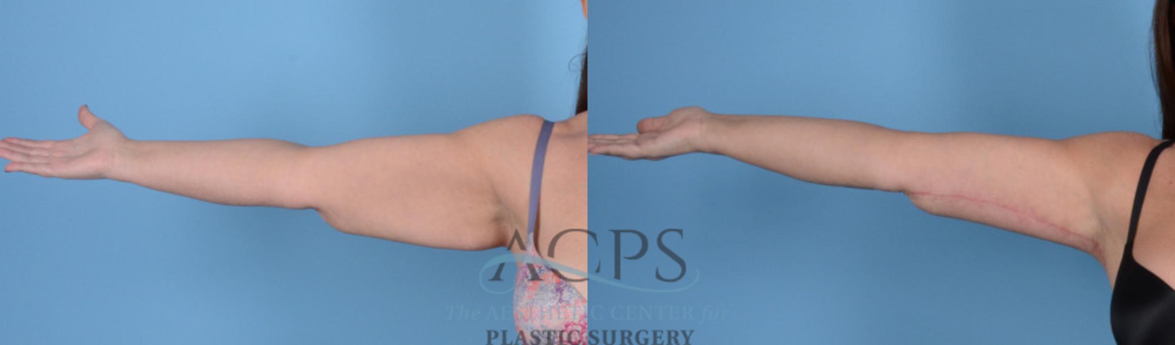 Before & After Arm Lift Case 767 Left Side View: View in Houston, TX