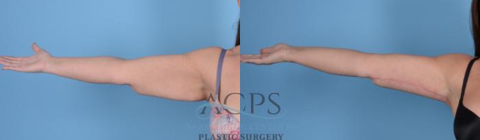 Before & After Arm Lift Case 767 Left Side View: View in Houston, TX