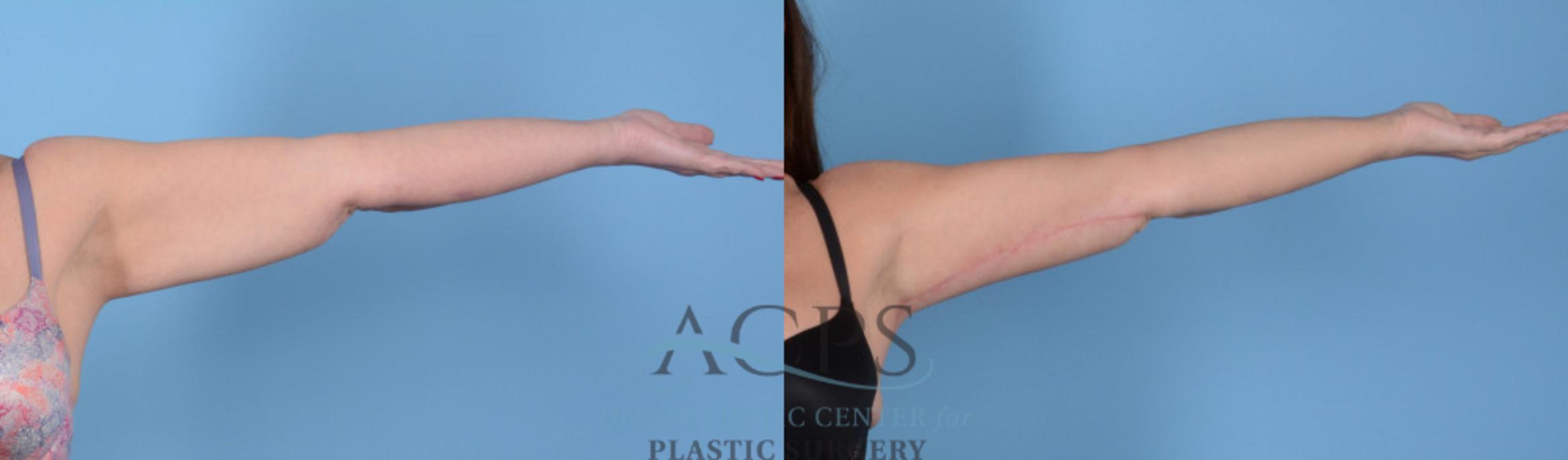 Before & After Arm Lift Case 767 Right Side View: View in Houston, TX