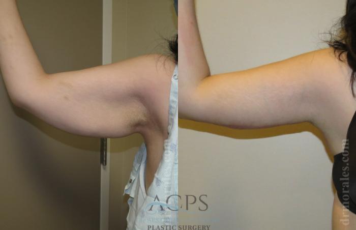 Before & After Arm Lift Case 768 Left Side View: View in Houston, TX