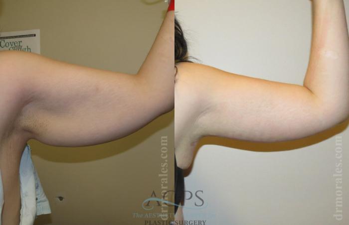 Before & After Arm Lift Case 768 Right Side View: View in Houston, TX