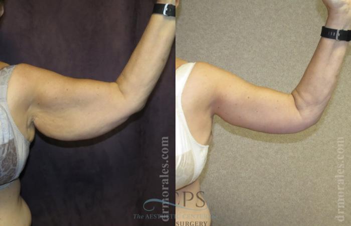 Before & After Arm Lift Case 769 Front View: View in Houston, TX