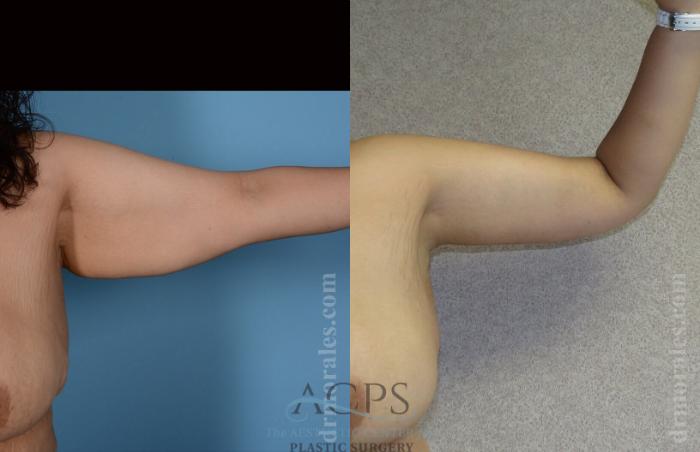 Before & After Arm Lift Case 770 Front View: View in Houston, TX