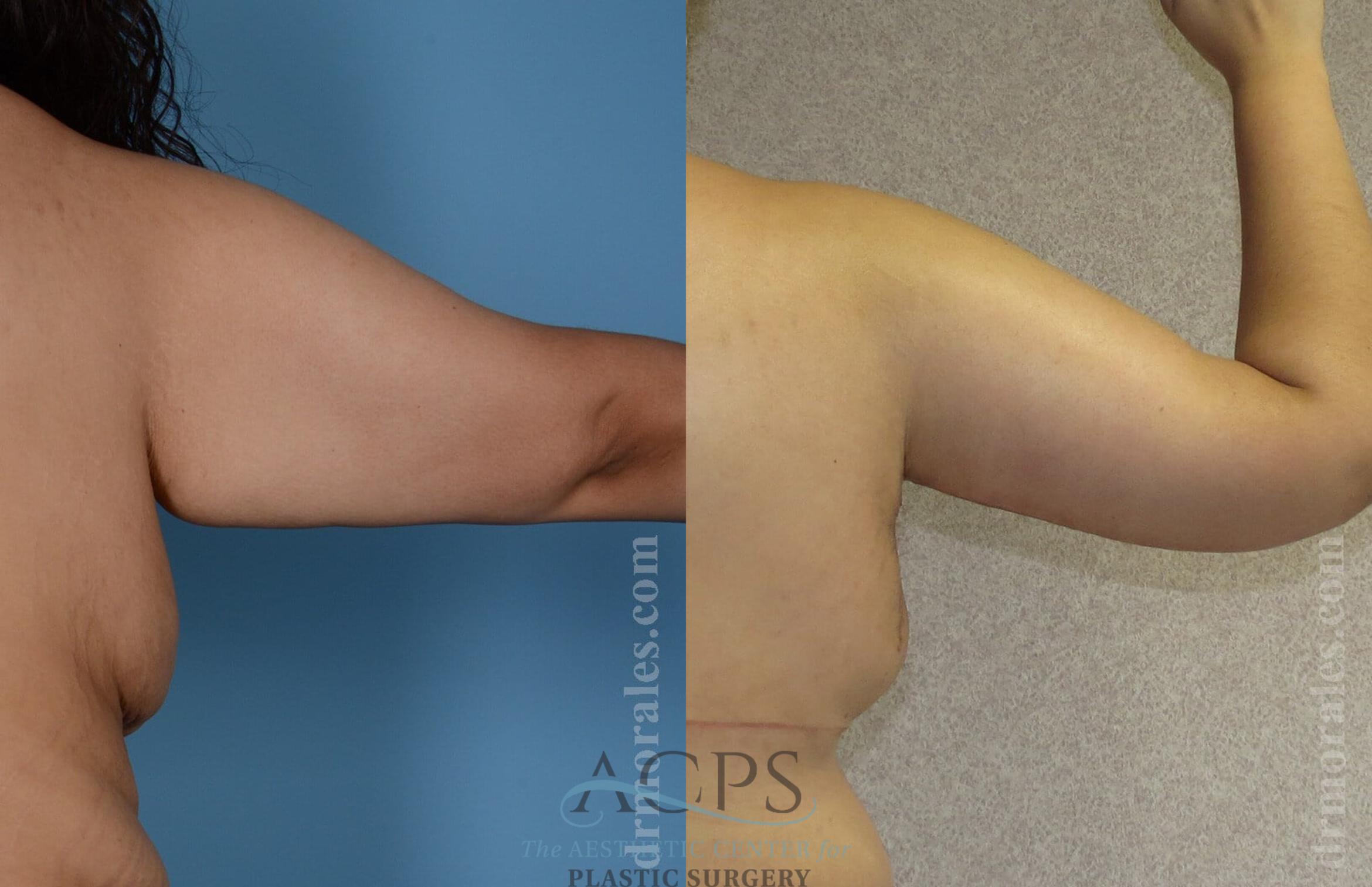Before & After Arm Lift Case 770 Rear View: View in Houston, TX