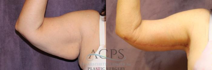 Before & After Arm Lift Case 771 Front View: View in Houston, TX
