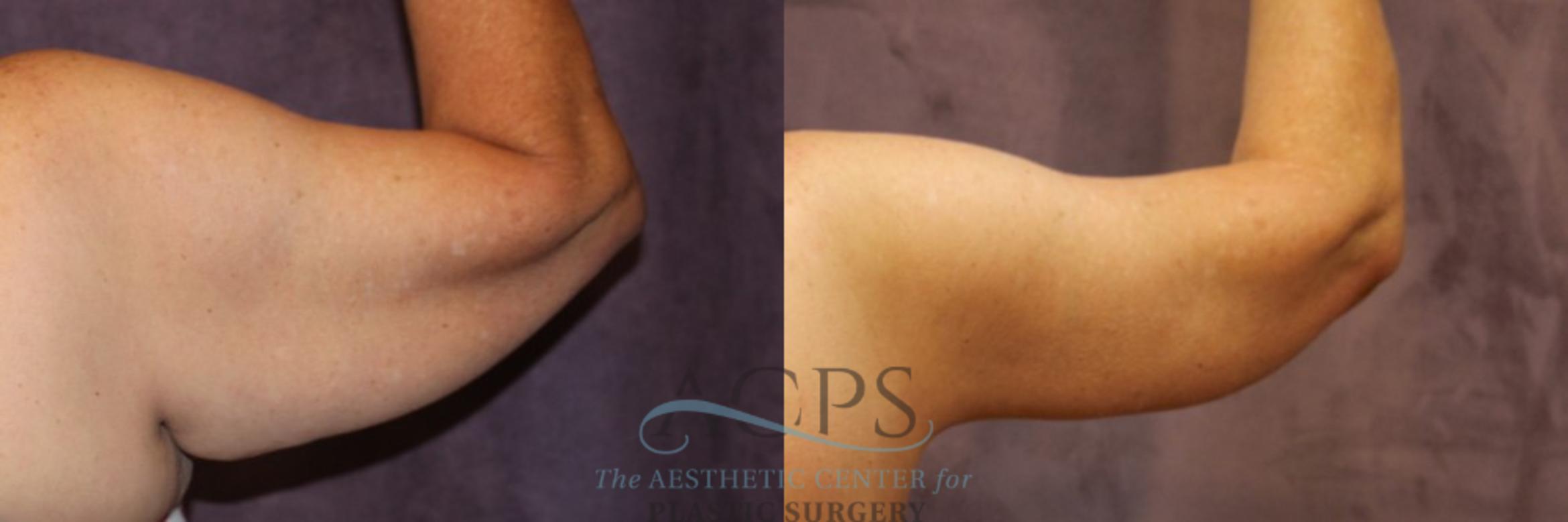 Before & After Arm Lift Case 771 Rear View: View in Houston, TX