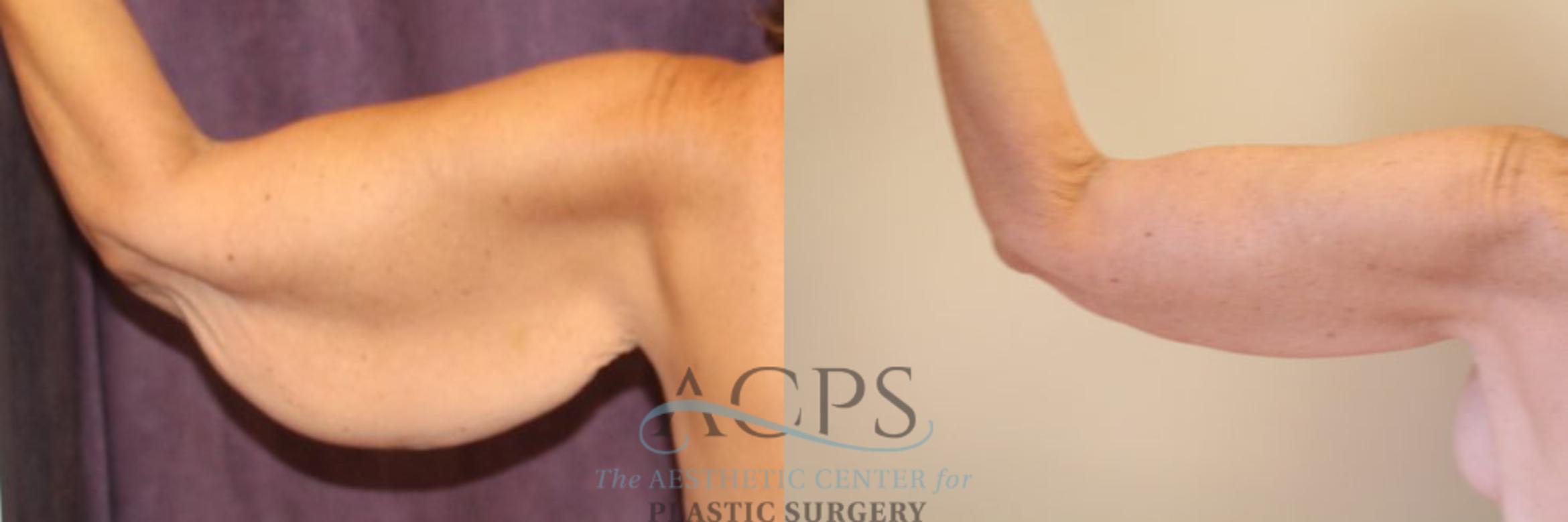 Before & After Arm Lift Case 772 Rear View: View in Houston, TX