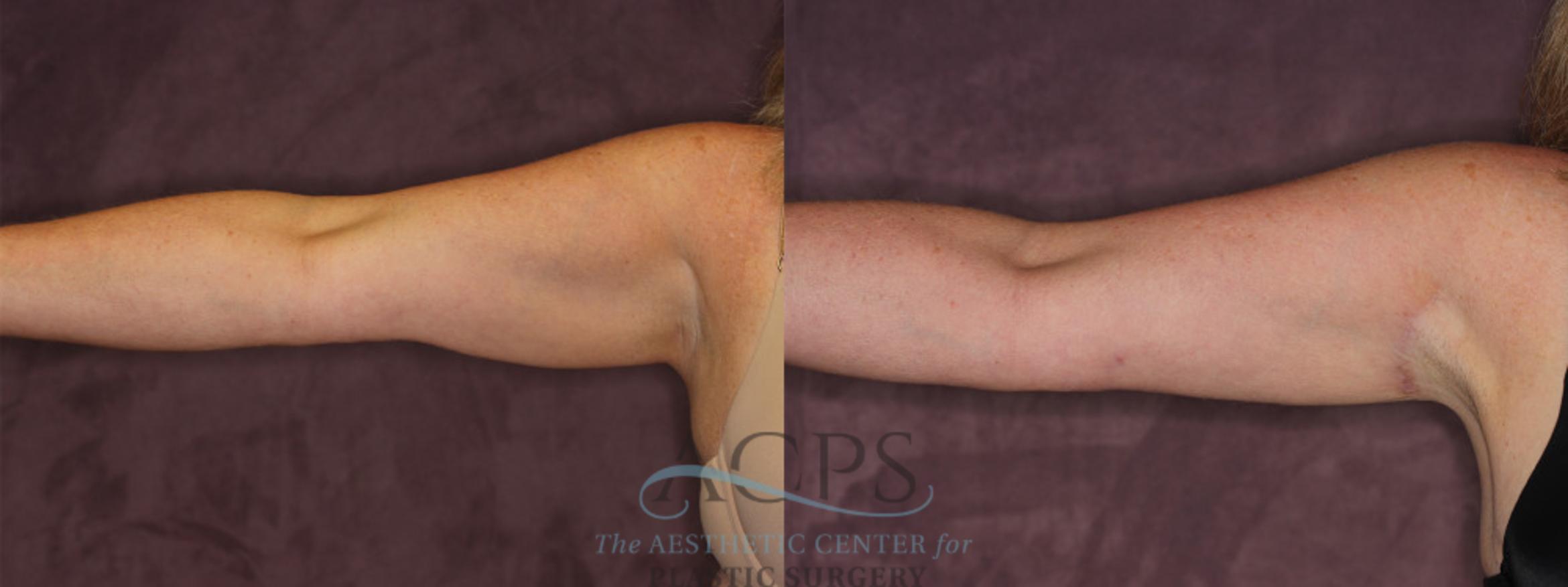 Before & After Arm Lift Case 773 Front Left View: View in Houston, TX