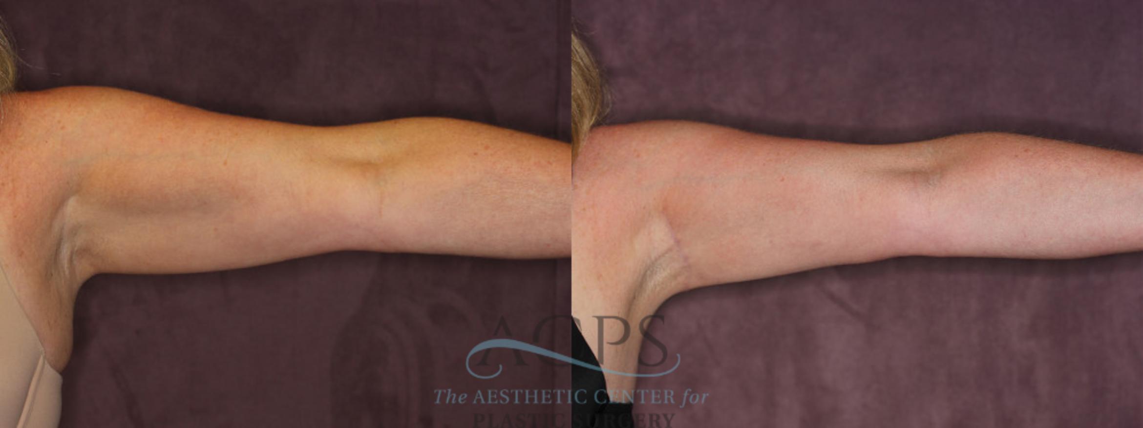 Before & After Arm Lift Case 773 Front Right View: View in Houston, TX