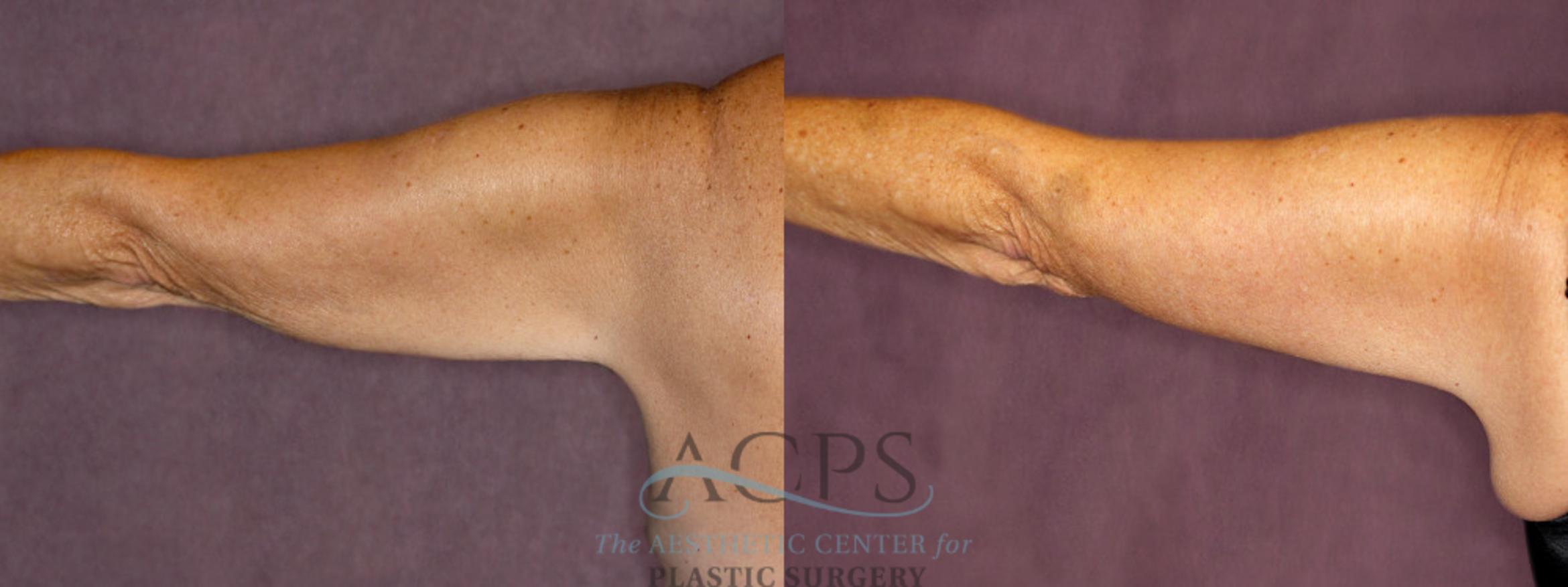 Before & After Arm Lift Case 774 Back Left View: View in Houston, TX