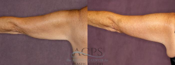Before & After Arm Lift Case 774 Back Left View: View in Houston, TX