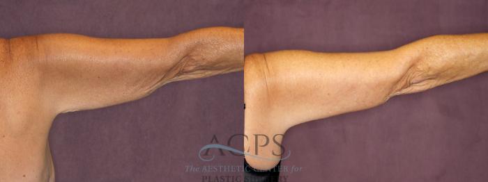 Before & After Arm Lift Case 774 Back Right View: View in Houston, TX