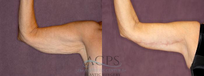 Before & After Arm Lift Case 774 Front Left View: View in Houston, TX