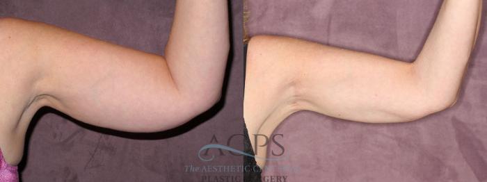 Before & After Arm Lift Case 775 Side Right View: View in Houston, TX
