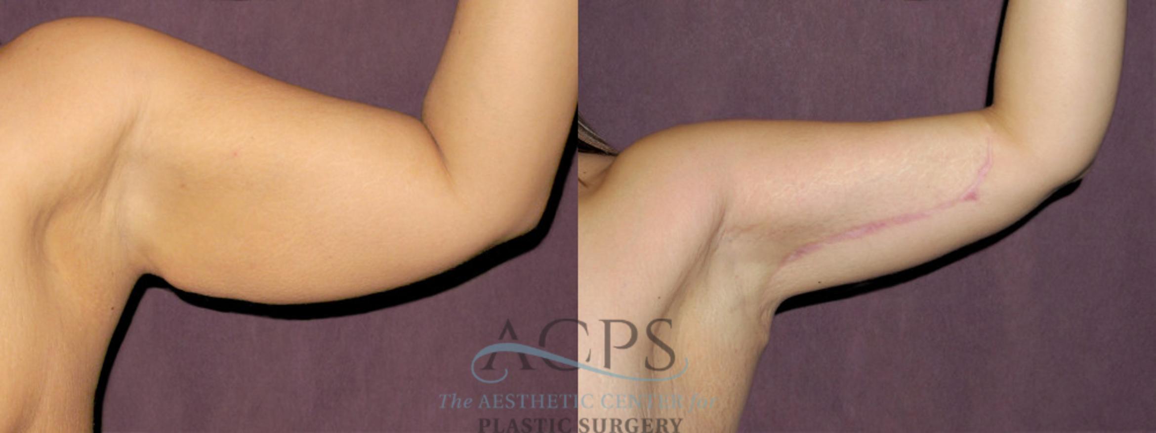 Before & After Arm Lift Case 777 Side Left View: View in Houston, TX
