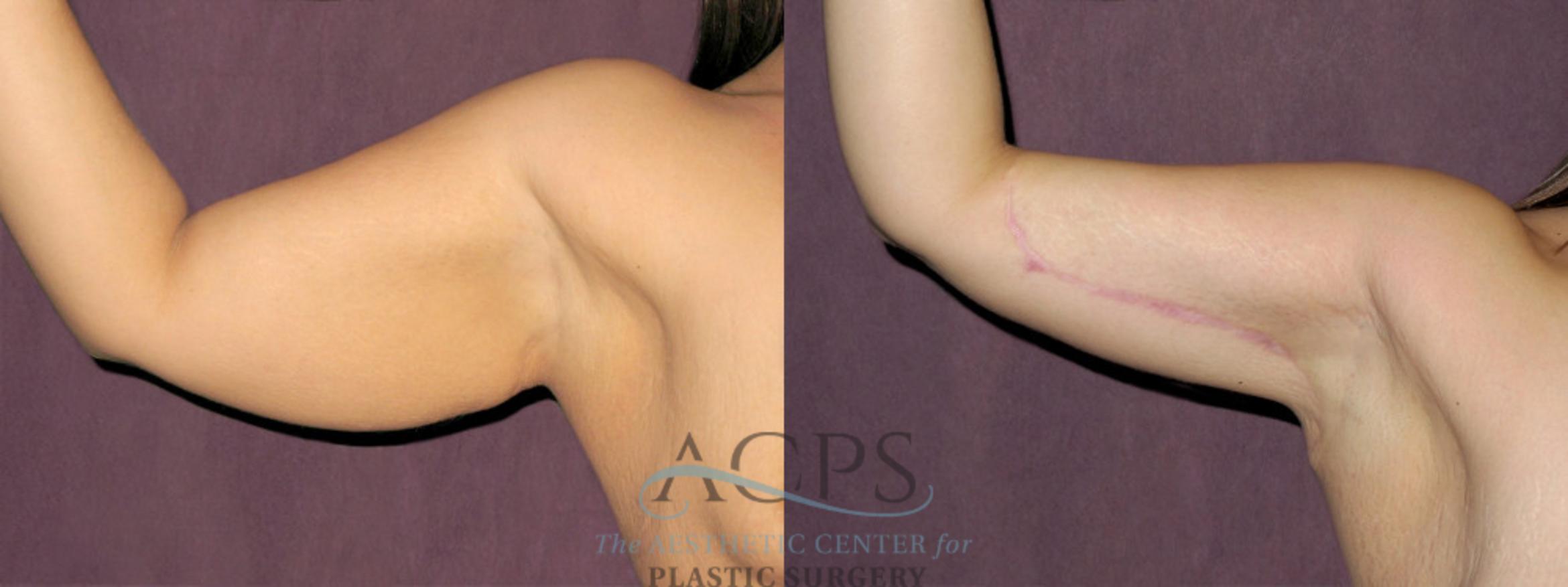 Before & After Arm Lift Case 777 Side Right View: View in Houston, TX