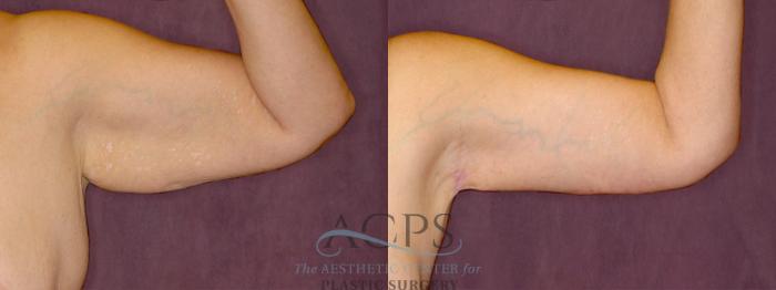 Before & After Arm Lift Case 778 Side Left View: View in Houston, TX