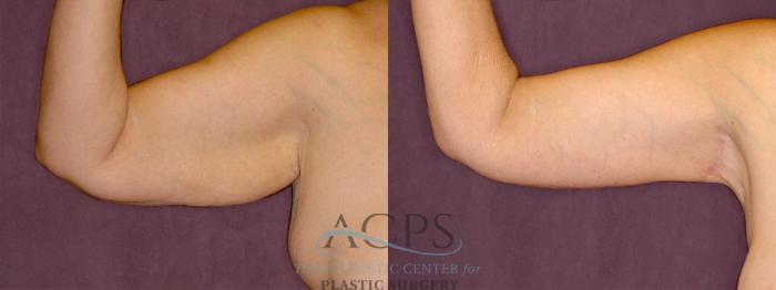 Before & After Arm Lift Case 778 Side Right View: View in Houston, TX