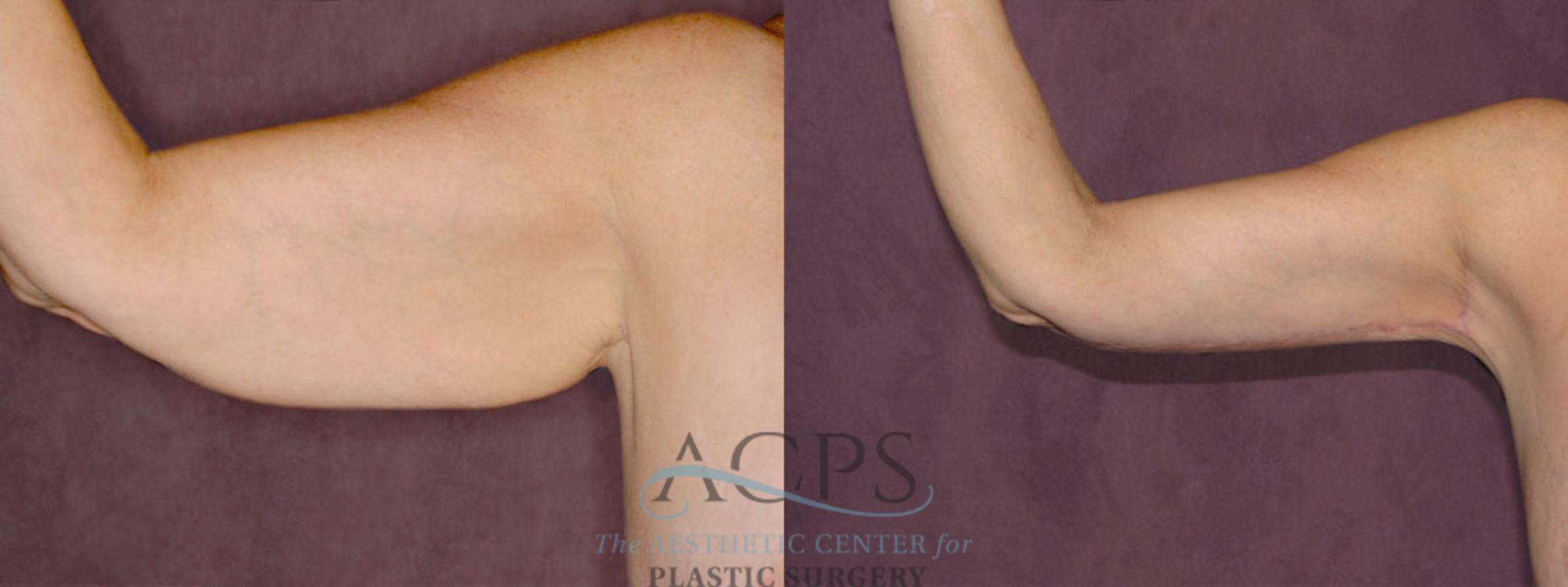 Before & After Arm Lift Case 779 Front View: View in Houston, TX