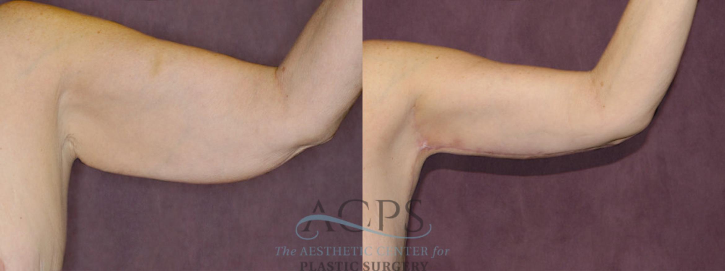 Before & After Arm Lift Case 779 Side View: View in Houston, TX