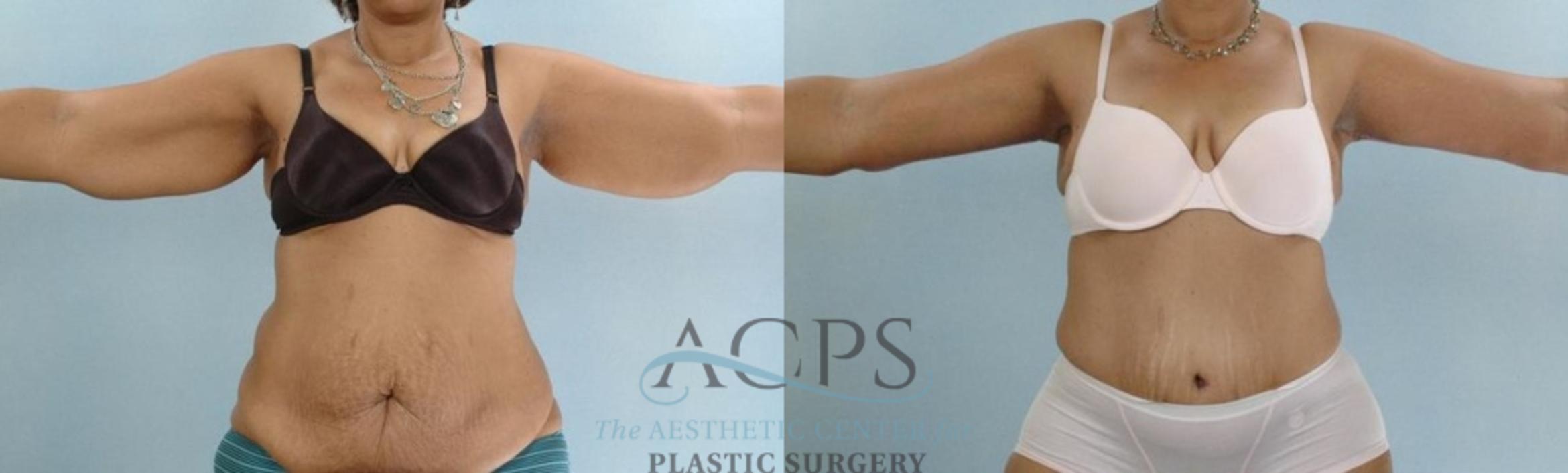 Before & After Arm Lift Case 780 Front View: View in Houston, TX