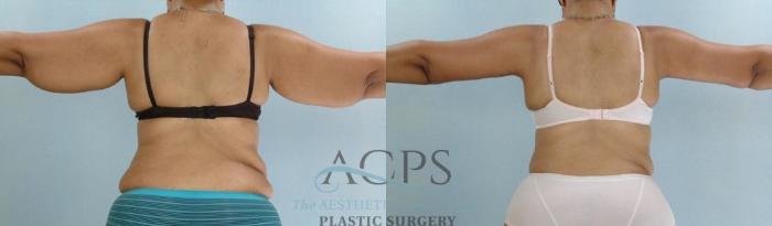 Before & After Arm Lift Case 780 Rear View: View in Houston, TX