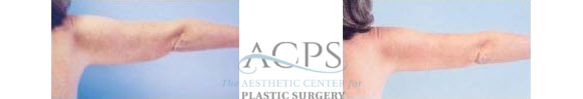 Before & After Arm Lift Case 781 Side View: View in Houston, TX