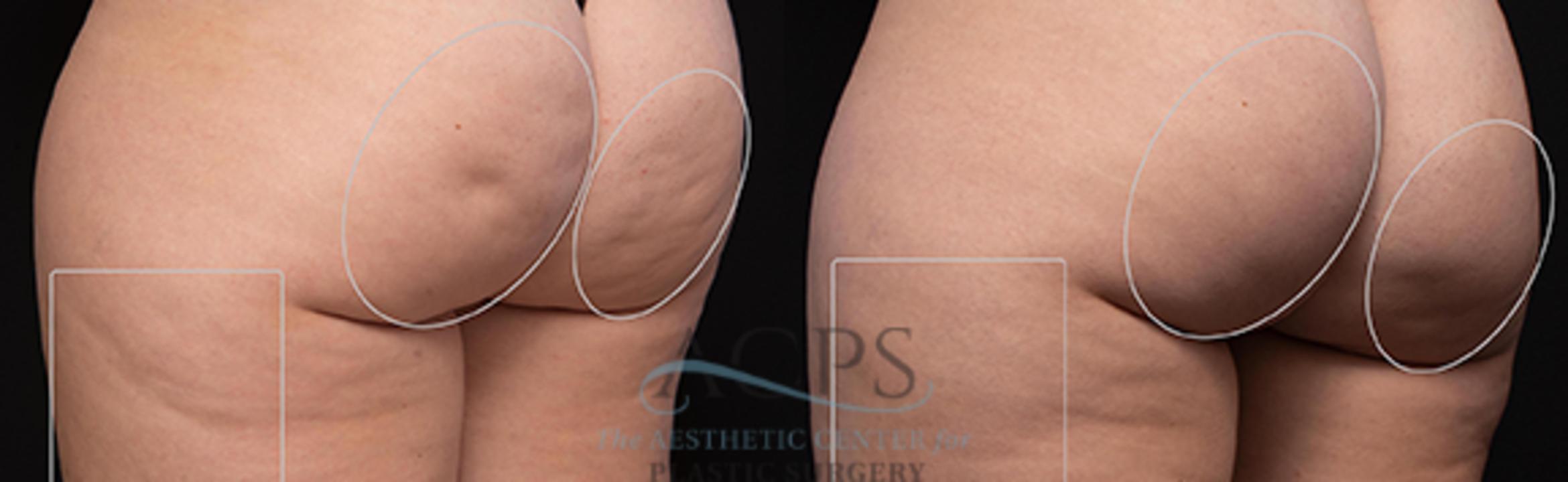 Before & After Avéli Cellulite Treatment Case 1431 Rear View: View in Houston, TX