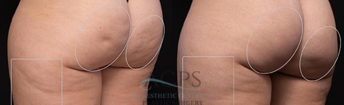 Before & After Avéli Cellulite Treatment Case 1431 Rear View: View in Houston, TX