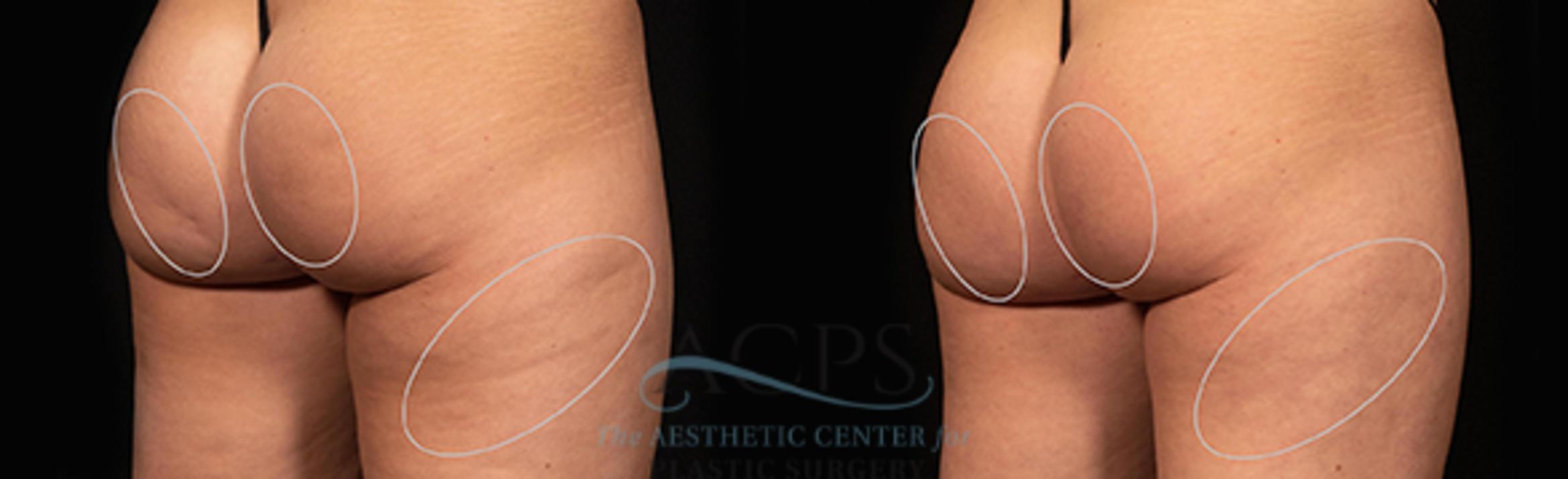 Before & After Avéli Cellulite Treatment Case 1432 Rear View: View in Houston, TX
