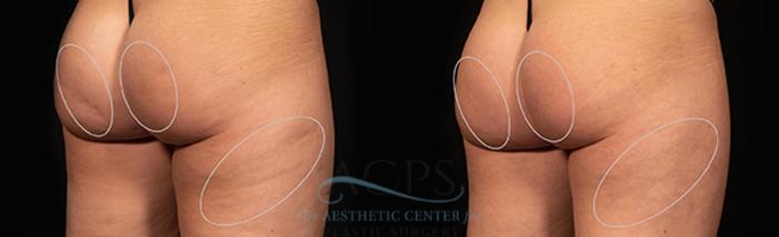 Before & After Avéli Cellulite Treatment Case 1432 Rear View: View in Houston, TX