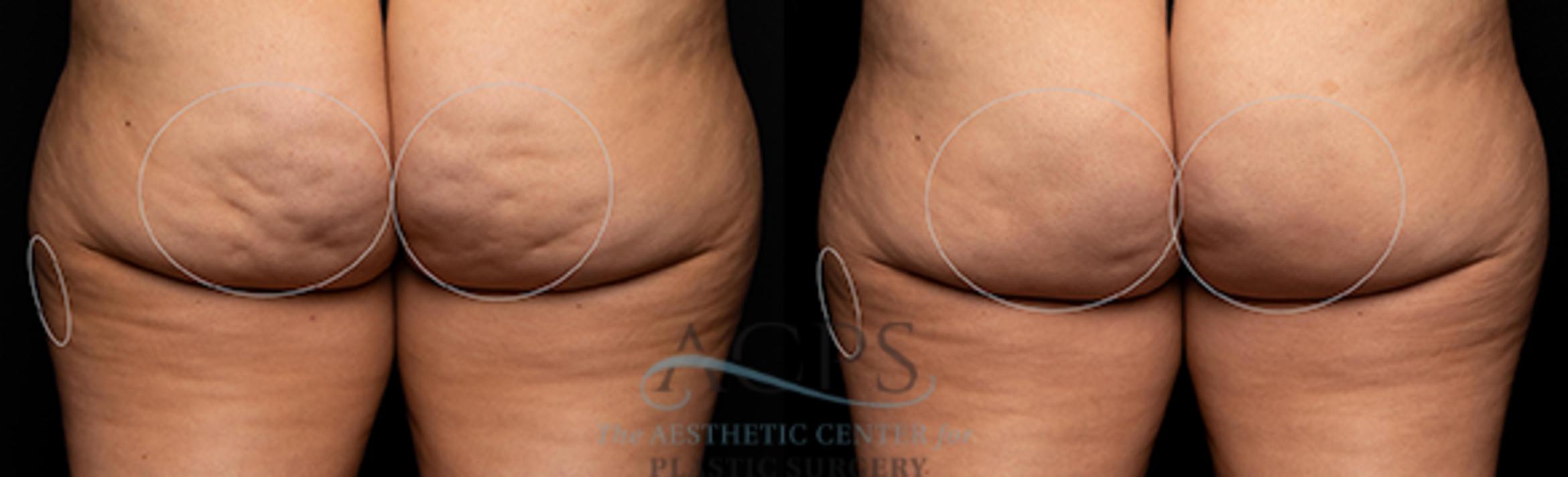 Before & After Avéli Cellulite Treatment Case 1433 Rear View: View in Houston, TX