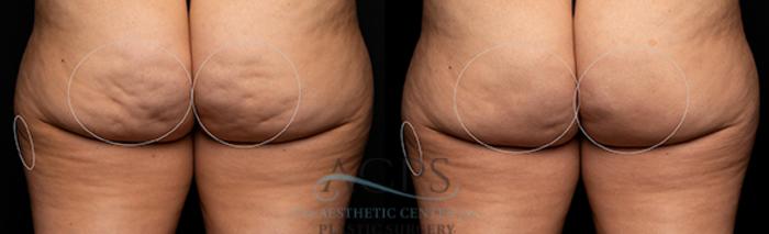 Before & After Avéli Cellulite Treatment Case 1433 Rear View: View in Houston, TX