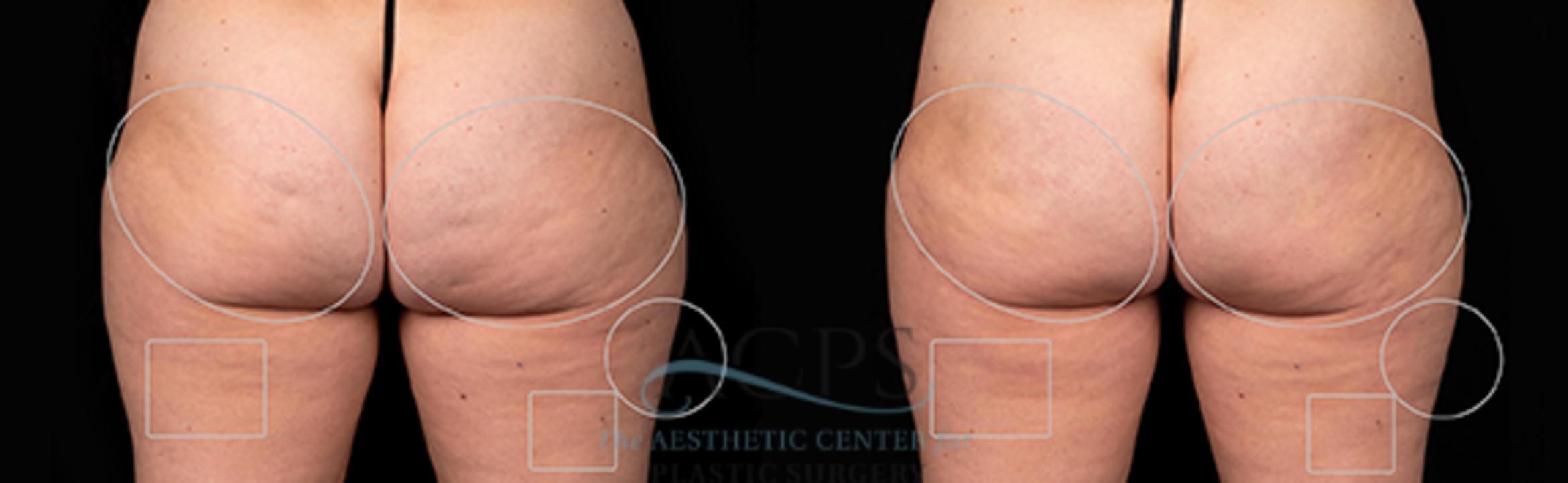 Before & After Avéli Cellulite Treatment Case 1434 Rear View: View in Houston, TX