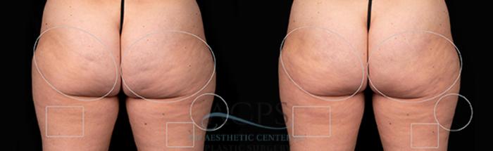 Before & After Avéli Cellulite Treatment Case 1434 Rear View: View in Houston, TX