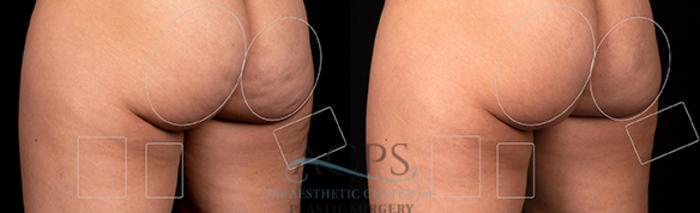Before & After Avéli Cellulite Treatment Case 1435 Rear View: View in Houston, TX