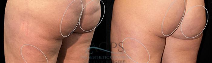 Before & After Avéli Cellulite Treatment Case 1436 Rear View: View in Houston, TX