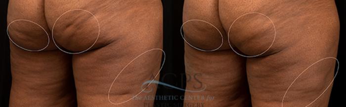 Before & After Avéli Cellulite Treatment Case 1437 Rear View: View in Houston, TX