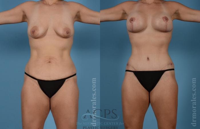 Before & After Body Lift Case 703 Front View: View in Houston, TX