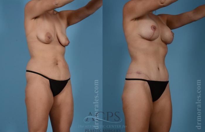 Before & After Body Lift Case 703 Oblique View: View in Houston, TX