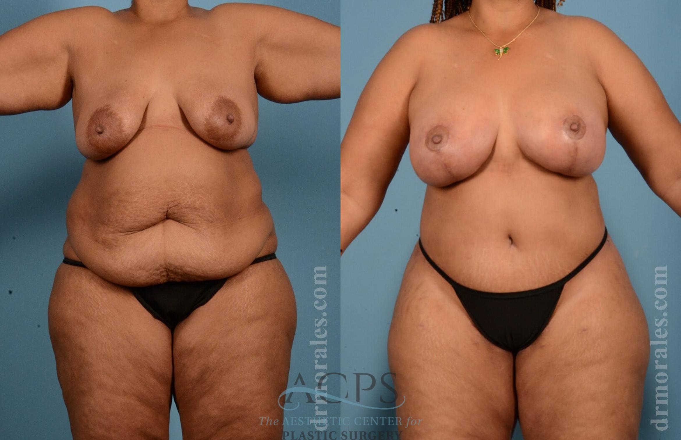 Before & After Body Lift Case 704 Front View: View in Houston, TX